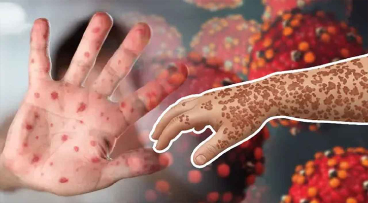 হামের উপসর্গে প্রাণ গেল আরও ৭ শিশুর