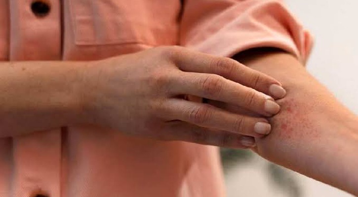 গরমে ত্বকে র‍্যাশ উঠলে কী করবেন, কী করবেন না