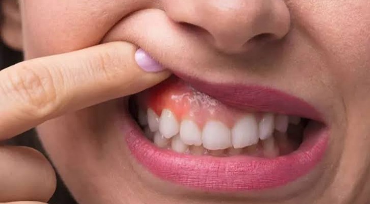 দাঁতের মাড়ি ফুলে গেলে কী করবেন