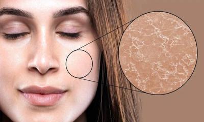 রোজায় ত্বক শুষ্ক হয়ে যাচ্ছে?