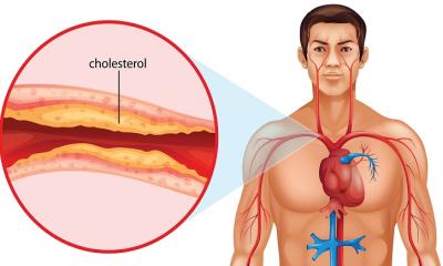 শরীরে ভালো কোলেস্টেরল হৃদরোগের ঝুঁকি কমাবে