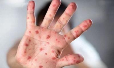 হাম ও হামের উপসর্গ নিয়ে আরও ১০ শিশুর মৃত্যু