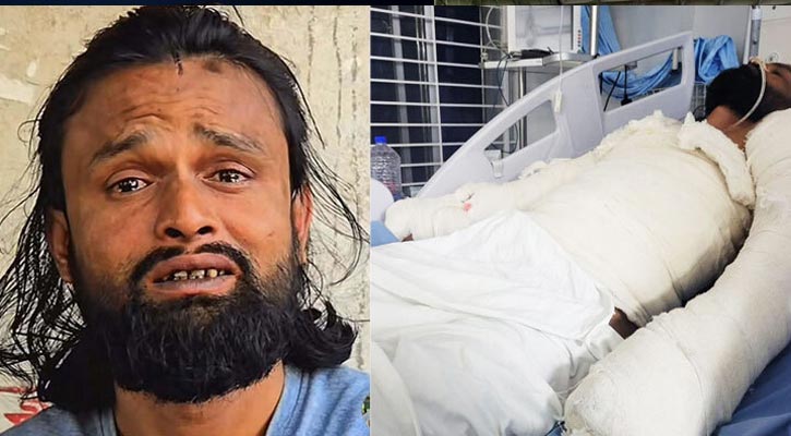 মানুষকে হাসাতে গিয়ে হাসপাতালে—অগ্নিদগ্ধ আল-আমিন এখন উন্নতির পথে