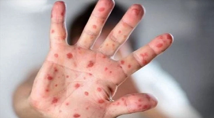 হাম ও হামের উপসর্গ নিয়ে আরও ১০ শিশুর মৃত্যু