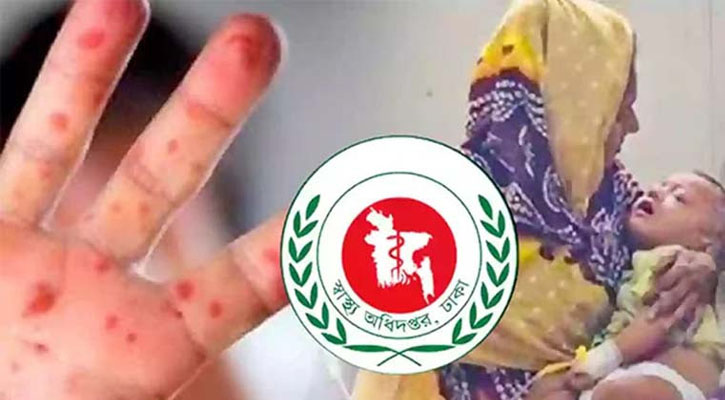 হাম ও হামের উপসর্গে মৃত্যু ৬০০ ছাড়াল