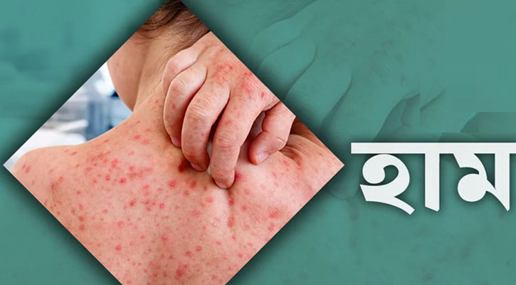 ময়মনসিংহে হামের উপসর্গে আরও ৪ শিশুর মৃত্যু