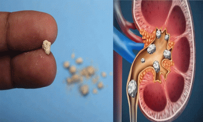 কিডনিতে পাথর হওয়া রোধে যা করবেন