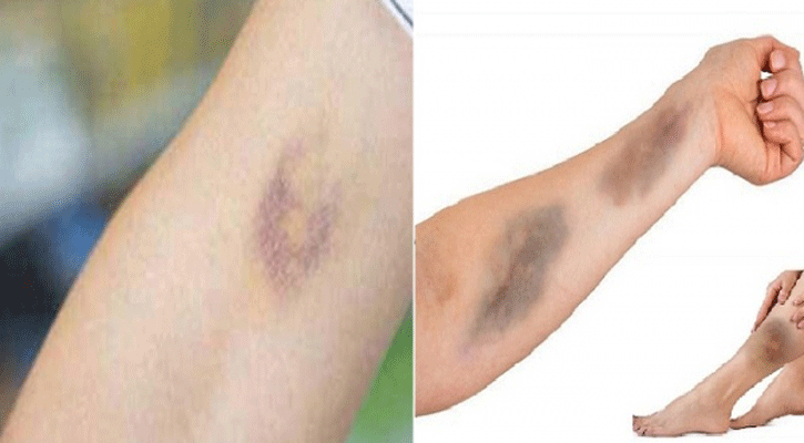 শরীরে কালচে দাগ কেন হয়