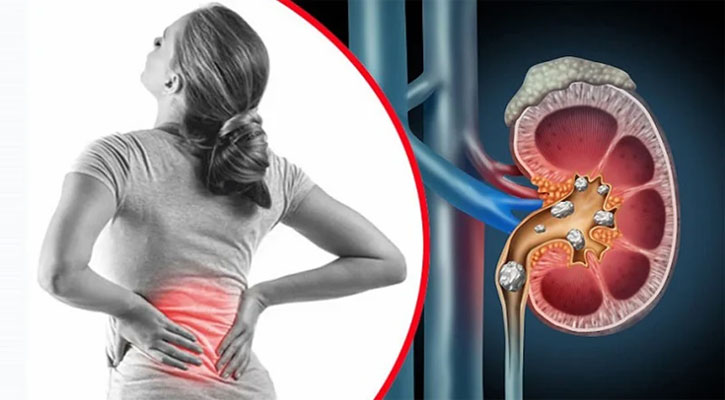 যে ফলগুলো কিডনিতে পাথর হওয়ার ঝুঁকি কমায়