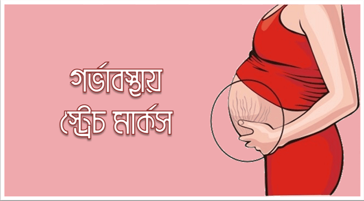 স্ট্রেস মার্ক দূর করার ঘরোয়া উপায়