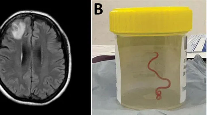 মানব মস্তিষ্কে জীবন্ত কৃমি, বিশ্বের প্রথম ঘটনা